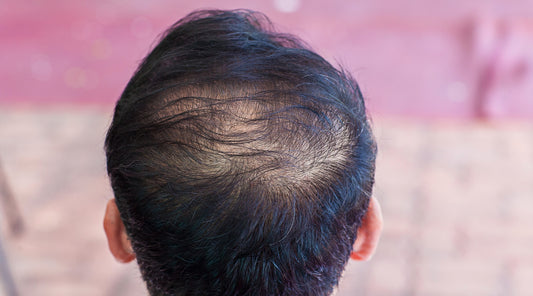 Moški tip izpadanja las - Kako ga zdraviti?