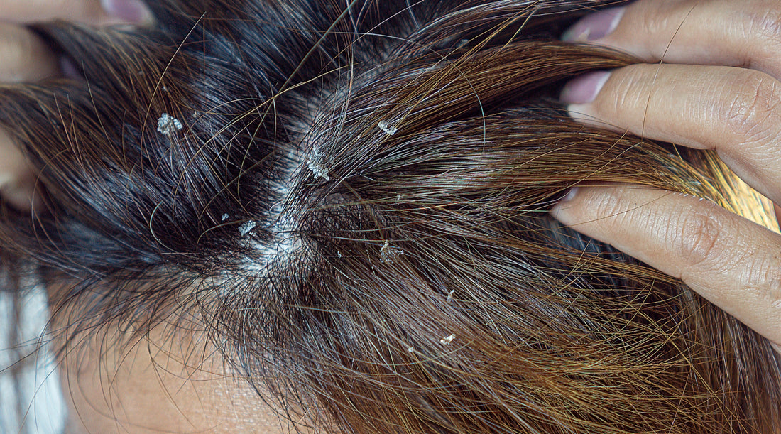 Seboroični dermatitis lasišča je glavni povzročitelj prhljaja