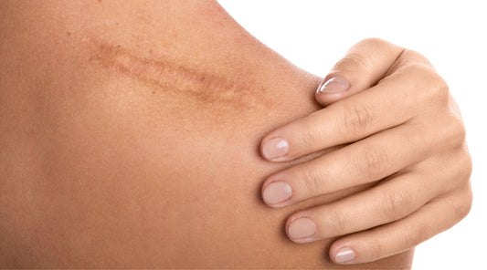 Kako pospešiti celjenje brazgotin na koži?