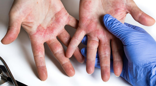 Kronični dermatitis rok - Pogosta kožna bolezen delovne populacije