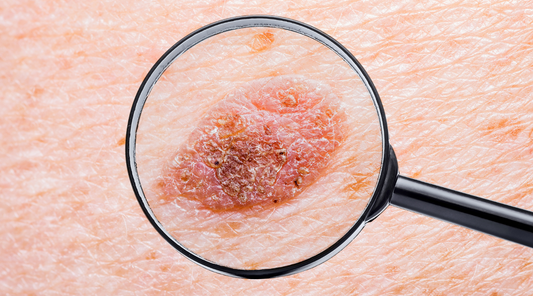 Ko kožni izpuščaj preraste v kožnega raka