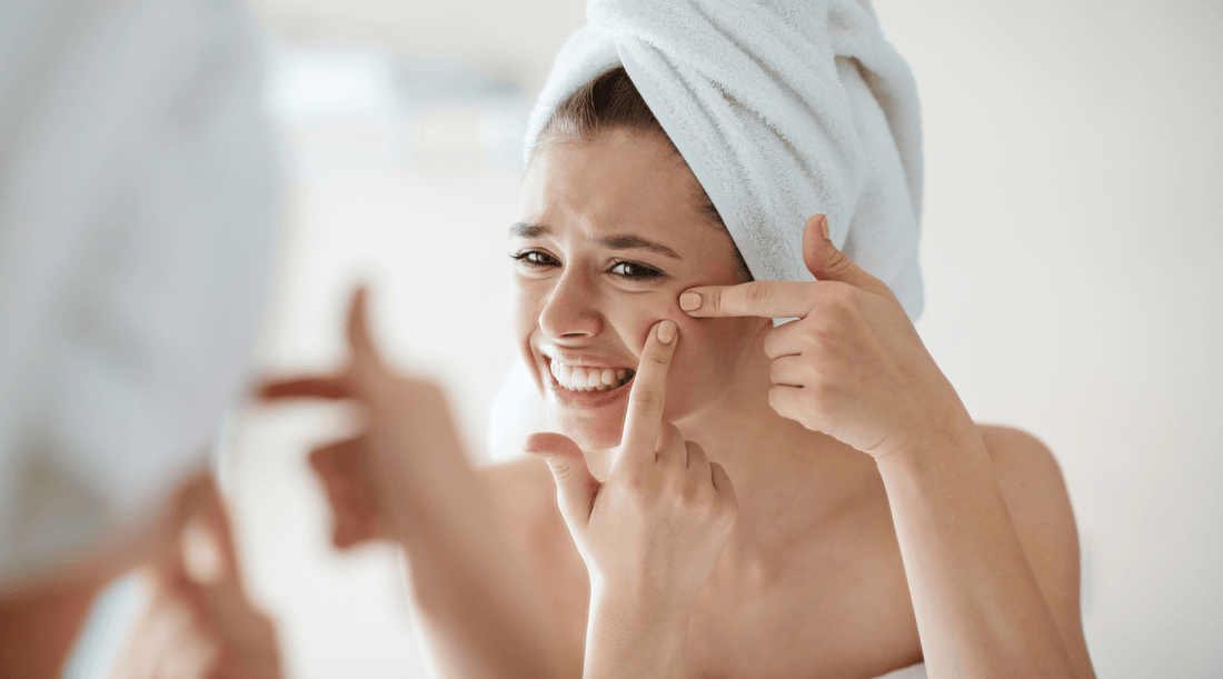 Akne niso kozmetična bolezen | Najzdravnik